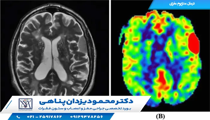 درمان مننژیوم مغزی